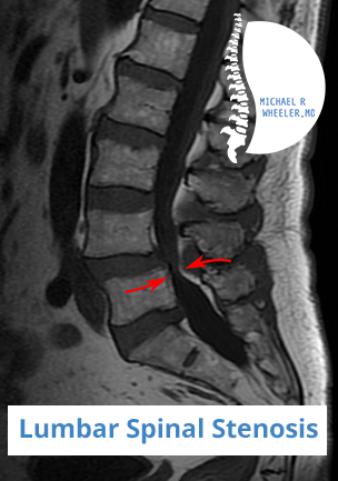 Dallas Lumber Spinal Stenosis