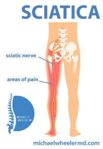 Dallas Sciatica Treatment