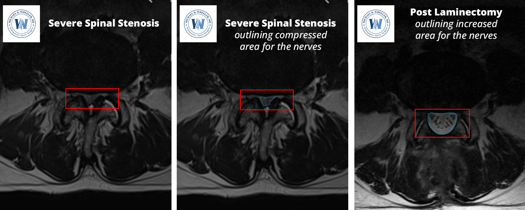 Dallas Lumbar Laminectomy